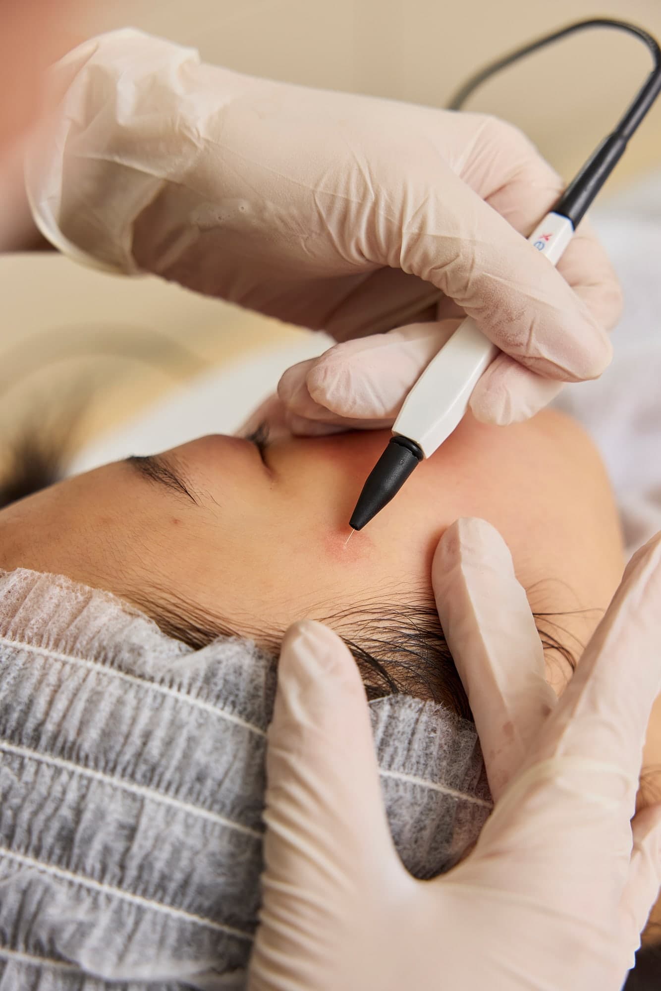Bir danışanın alnında SkinPen başlığı