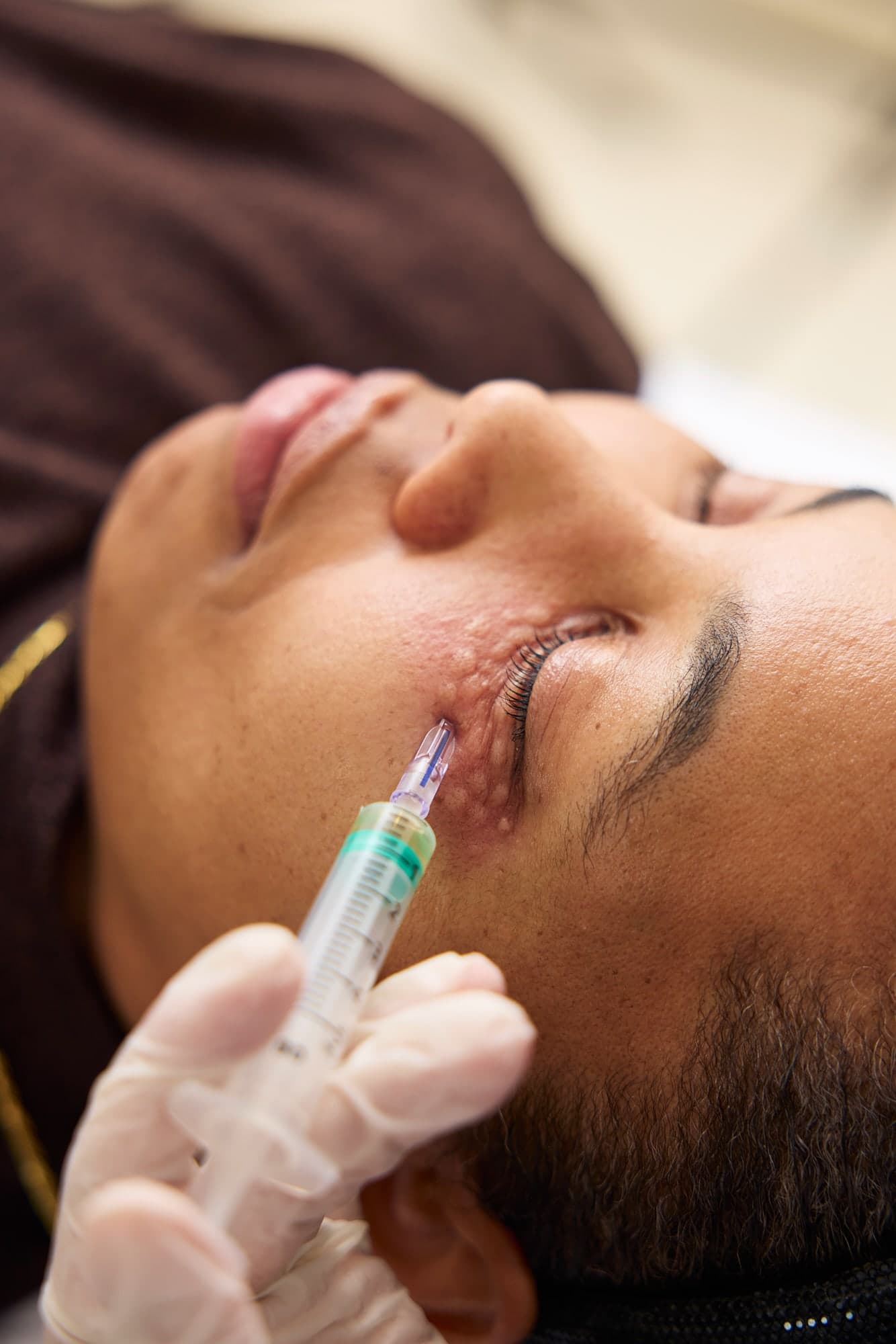 Göz altına skin booster uygulanıyor