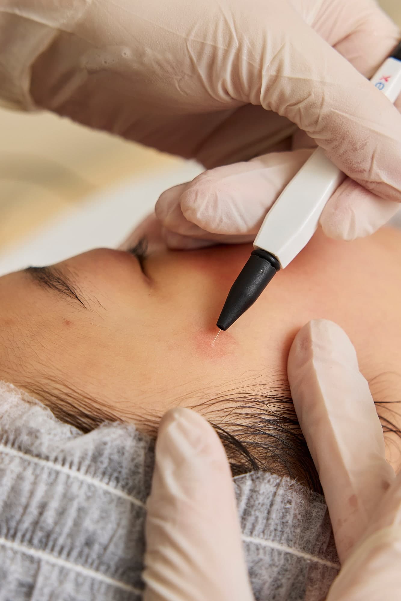 Rotterdam'da bir Diba Clinics danışanına SkinPen ile microneedling