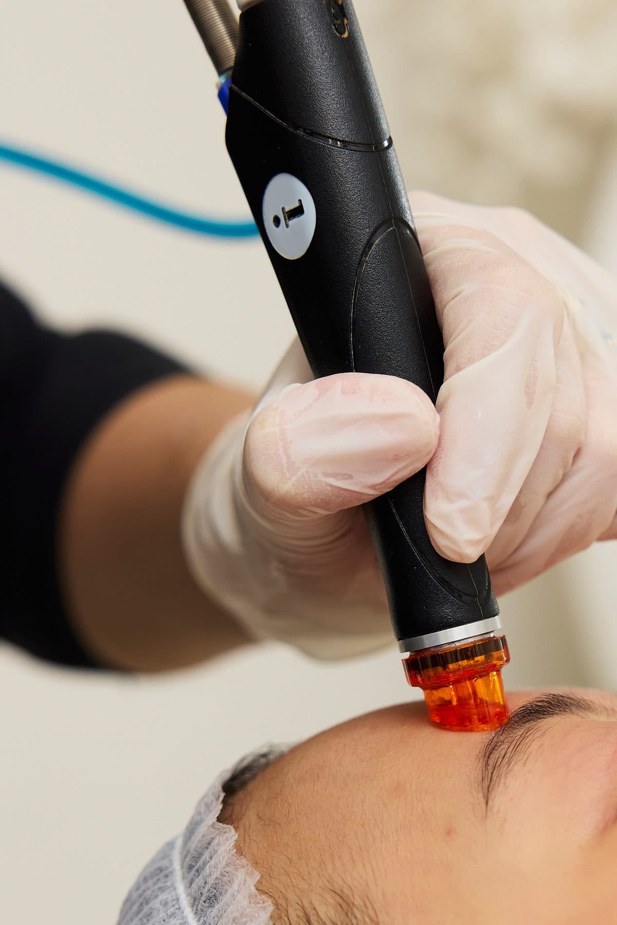 Cilt üzerinde Dermapen 4 başlığı